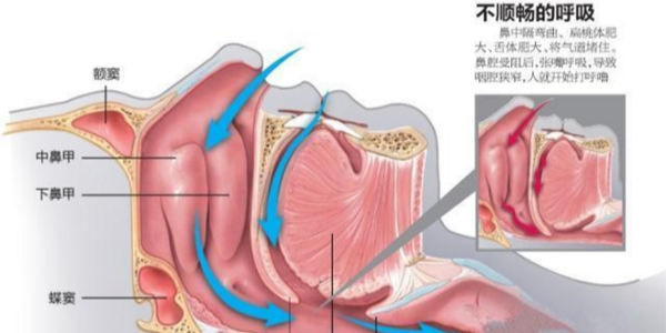 家用呼吸機(jī)是如何治療打鼾