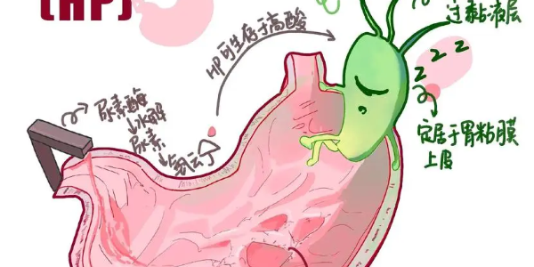 【必看】幽門螺桿菌真相揭示，別再忽視你的胃痛了！