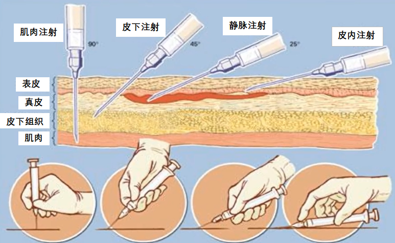 用注射器打針時傷神經怎么辦